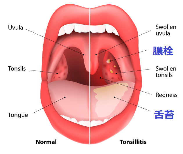 膿栓の図解