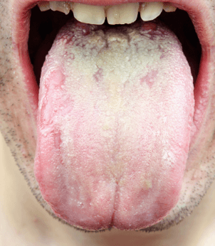 舌溝