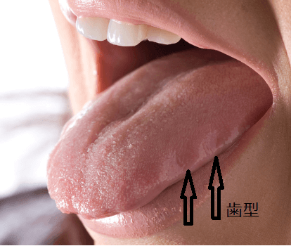 歯型がついている舌