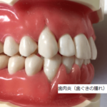 歯周病のチェック方法！こんな症状は要注意！？