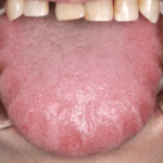 低位舌トレーニングの効果と正しい方法