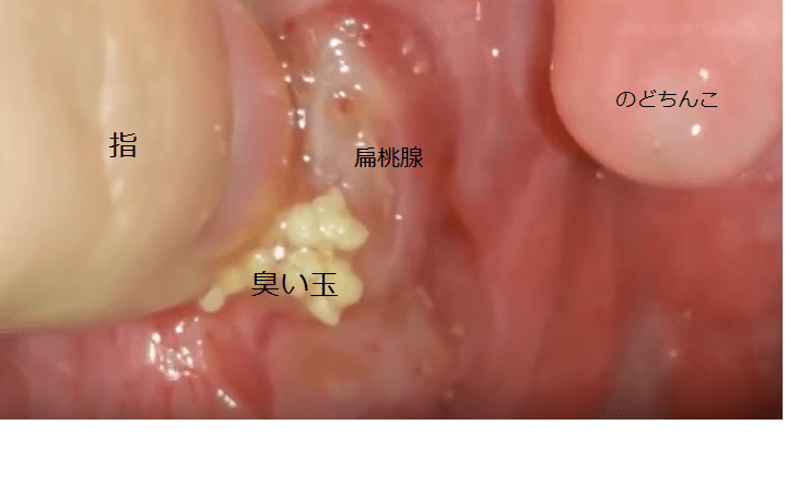 膿栓が見えない？膿栓のできる場所はここ！直接取るのは危険