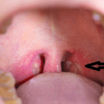 喉に白い塊が見えたらそれは臭い玉です。正しく取る方法とは？