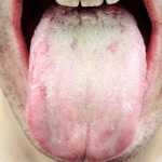急に舌に白い苔が！ヒリヒリする！それって口腔カンジダ症かも？