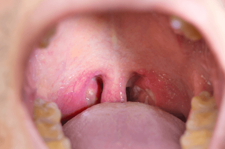 膿栓 のうせん 臭い玉って何 口臭との関係は 膿栓ができる体質は