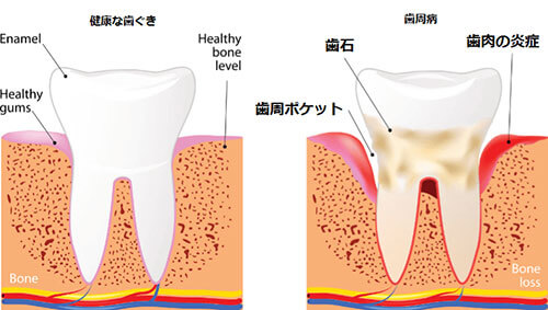 健康な歯ぐきと歯周病の歯ぐき