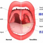 口臭の元「膿栓」を取り除き・予防する方法を知っていますか？