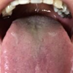 舌を磨いても舌苔がすぐたまる！？