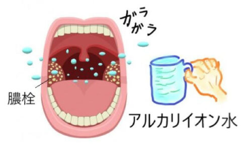 喉奥の膿栓（臭い玉）をアルカリイオン水でうがいして除去するイラスト。ガラガラうがいの様子と膿栓の位置が分かる図解。