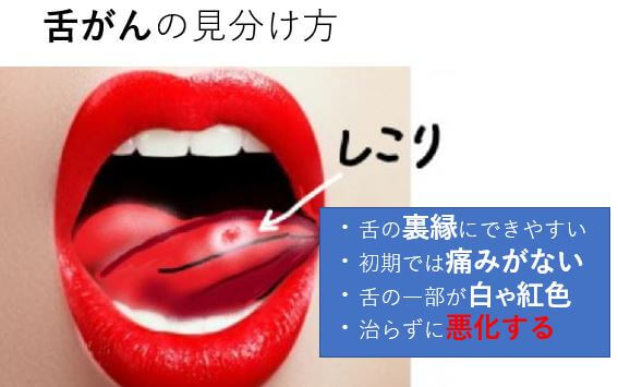 舌癌の見分け方の図