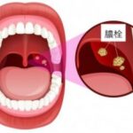 【膿栓大量出現】原因と解決法！口臭不安を一気に解消する方法を公開！
