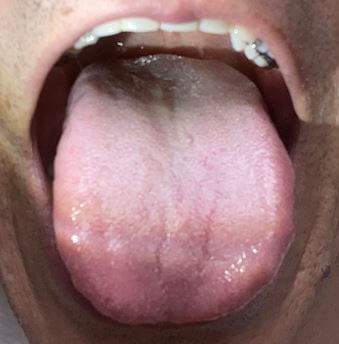 舌奥の舌苔