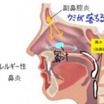後鼻漏（こうびろう）が原因の口臭！臭い対策と予防方法
