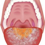 舌苔が多い人必見！原因と対策を詳しく解説