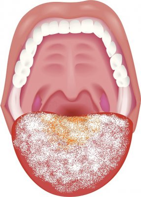 口腔カンジダ症の舌