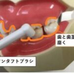 歯茎がブヨブヨで恥ずかしい！？腫れた歯茎の治し方はこうする。