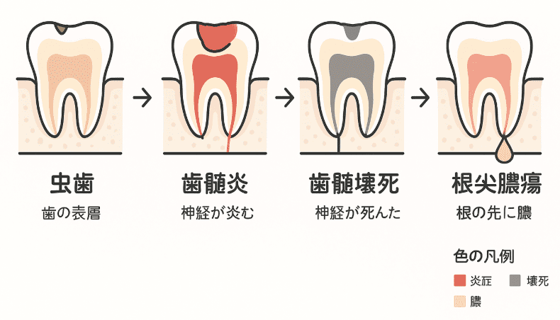 虫歯→歯髄炎→歯髄壊死→根尖膿瘍の進行図