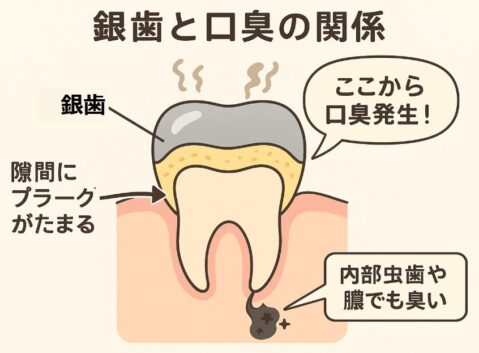 銀歯と口臭の関係を示す図解。銀歯と歯の隙間にプラークが溜まり、そこから口臭が発生するメカニズムや、内部の虫歯・膿も臭いの原因となることを日本語の説明付きで直感的に示したイラスト。
