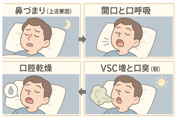 鼻づまり/OSA(上流要因)→開口→口呼吸→口腔乾燥→VSC増→朝の口臭