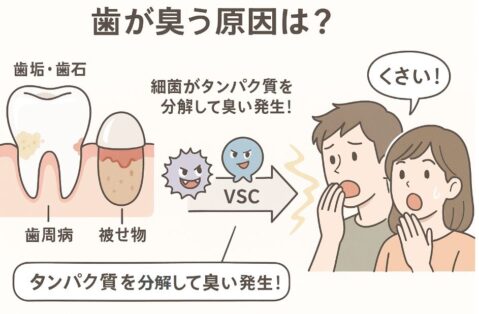 歯が臭う原因と仕組みを解説したアニメ風図解イラスト。