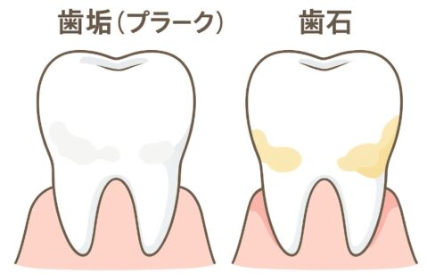 歯垢と歯石の違い：左の歯は白く柔らかい歯垢、右の歯は黄～茶色で硬い歯石が付着。歯ぐきの健康状態も左右で違いが分かるアニメ風比較図。
