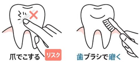 爪で歯垢を取ると歯にダメージやリスクがあることを示す線画イラスト。左は指の爪で歯をこすり、赤い×印と「リスク」ラベル付き。右は歯ブラシを正しく使い、きれいな歯と「歯ブラシで磨く」ラベルで安全性を強調。歯垢除去の正しい方法と爪による危険性を比較解説する図。