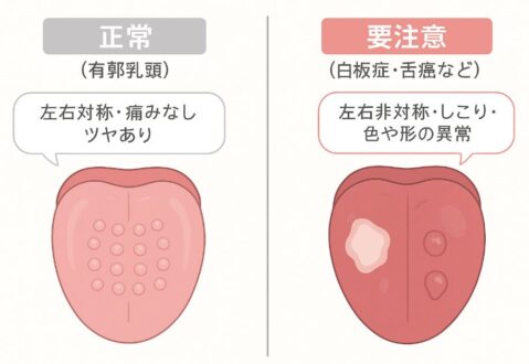 舌の正常な有郭乳頭（左右対称の丸いブツブツ）と、白板症・舌癌など重症例（左右非対称・しこり・異常な色や形）の比較イラスト