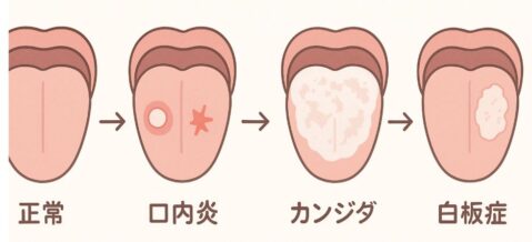 「口内炎」「カンジダ」「白板症」の違い図解