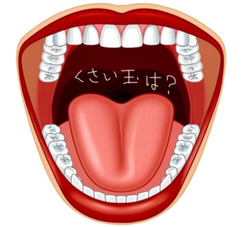 口臭があるけど臭い玉(膿栓）が見えない場合は、後鼻漏が口臭の原因かもしれないという解説画。