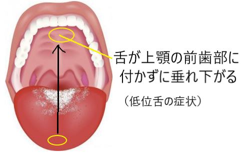 低位舌トレーニング：舌先を上あごと前歯の間に触れさせる。図解