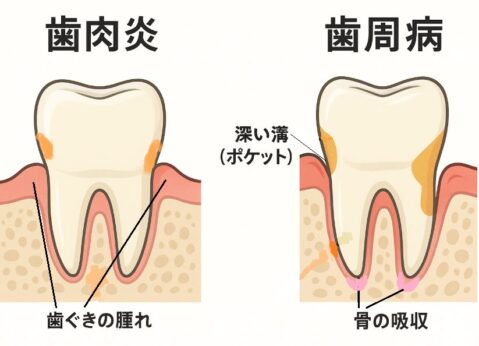 歯肉炎と歯周病の違い図解