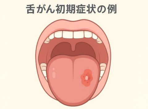 舌癌の初期症状例:口内炎と間違えやすい