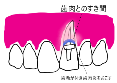 差し歯が臭い原因の説明イラスト図