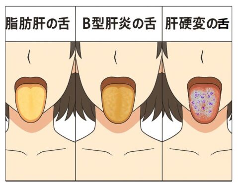 左は脂肪肝の舌、中央はＢ型肝炎の舌、右は肝硬変の舌。病気による舌の色や状態を表わしている図解