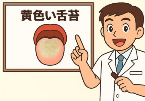 黄色舌苔について説明する歯医者さんのイラスト