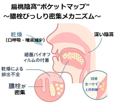 扁桃陰窩“ポケットマップ”～膿栓びっしり密集メカニズム～の図解