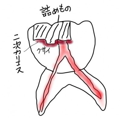 被せやインレーの内部が虫歯になっているケース事例の図解