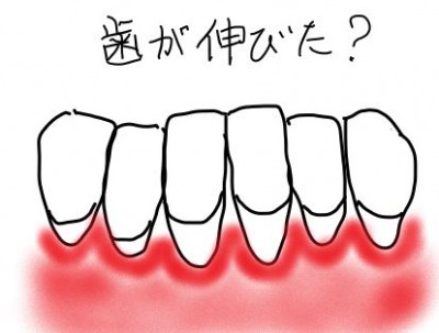 歯茎下がりで歯が伸びたように見える図