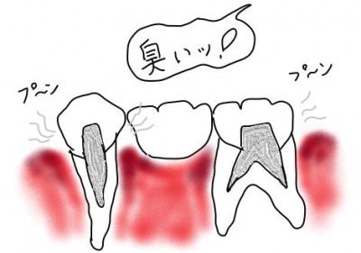ブリッジ歯が臭いを説明するためのイラスト