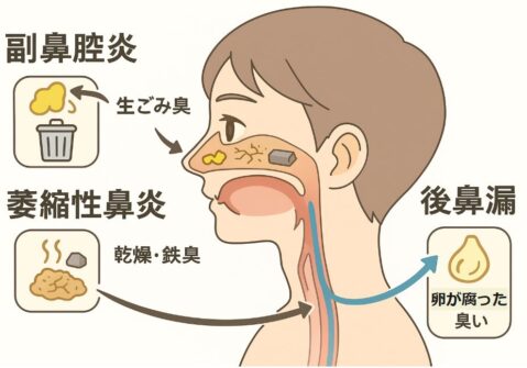 副鼻腔炎・萎縮性鼻炎・後鼻漏の原因部位と特徴的な臭いをわかりやすく解説した図。副鼻腔炎は生ごみ臭、萎縮性鼻炎は乾燥や鉄臭、後鼻漏は卵が腐った臭いが発生する経路をイラストで示している。