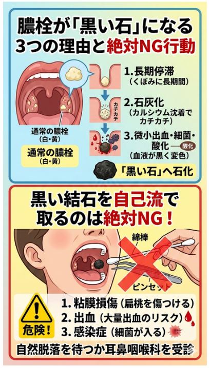 膿栓が黒く石灰化するメカニズムと、自分で取ってはいけない理由（粘膜損傷リスク）