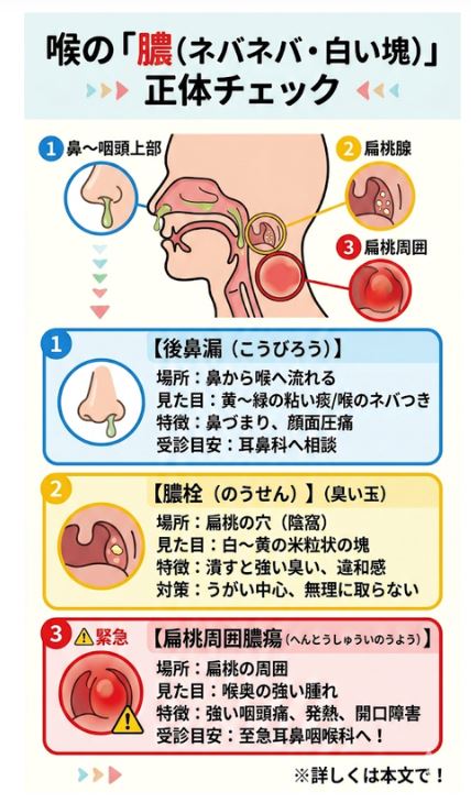 喉の膿汁・白い塊の正体と症状の違い(後鼻漏・膿栓・扁桃周囲膿瘍)