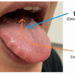 有郭乳頭（舌奥のぶつぶつ）の写真図解