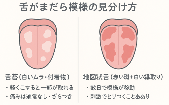 舌がまだら模様に見える原因|舌苔の白いムラと地図状舌の赤い斑の違い 図解