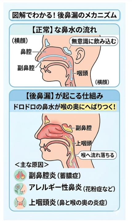 後鼻漏が起こるメカニズムと正常な鼻水の流れとの違いを示す人体断面図解