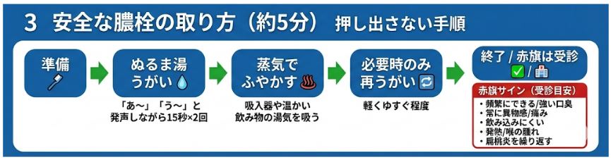【図解】約5分でできる押し出さない安全な膿栓の取り方フローチャート。準備からぬるま湯うがい、蒸気でふやかす手順を図示し、併せて耳鼻科受診が必要な赤旗サイン(頻繁な発生、痛みなど)もリスト化して掲載。