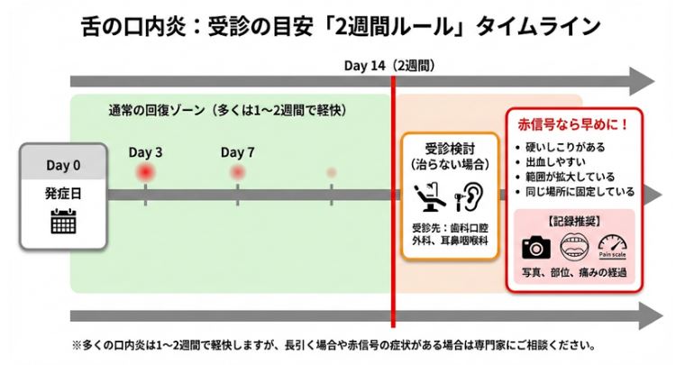 舌の口内炎が治るまでの経過を説明したタイムライン図解。発症から14日（2週間）を境界線とし、通常の回復ゾーンと、受診を検討すべき赤信号（硬いしこり、出血、範囲拡大、固定部位）の目安を解説。