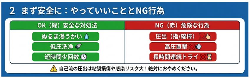 【図解】膿栓の安全な取り方(OK行動:ぬるま湯うがい、低圧洗浄など)と危険なNG行為(圧出、高圧直撃など)の比較表。自己流の圧出による粘膜損傷リスクへの警告文も記載。