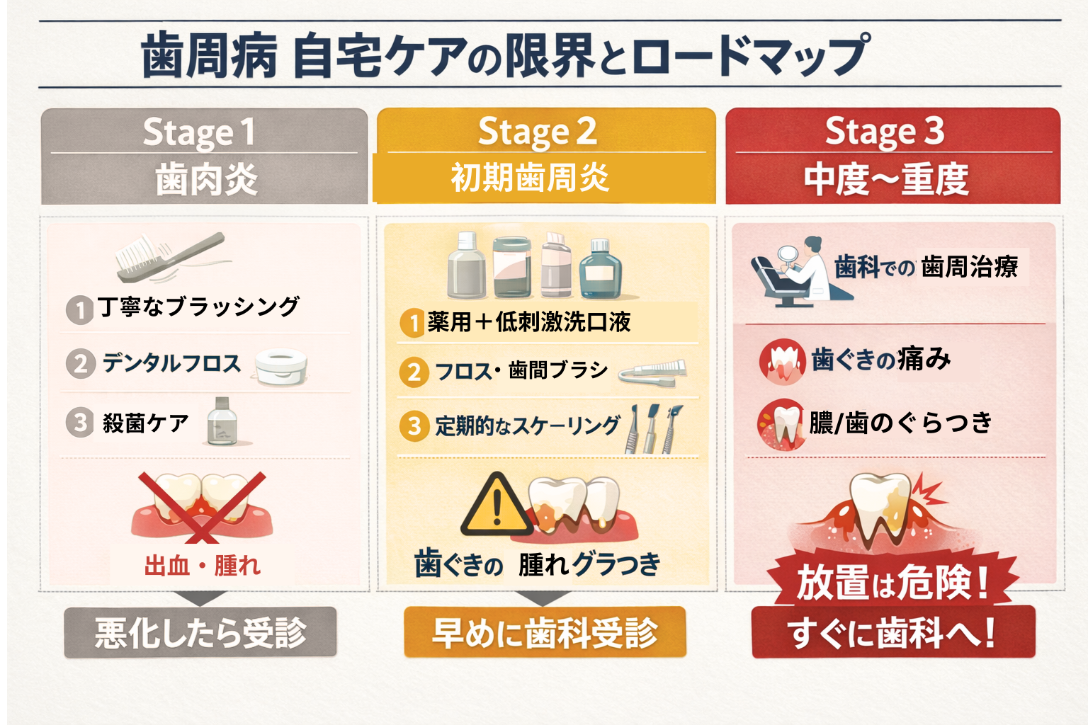 歯周病の進行をStage1歯肉炎・Stage2初期歯周炎・Stage3中度重度に分け、自宅ケア方法・今夜の3ステップ・歯科受診サインを比較したステージ別ロードマップ図解