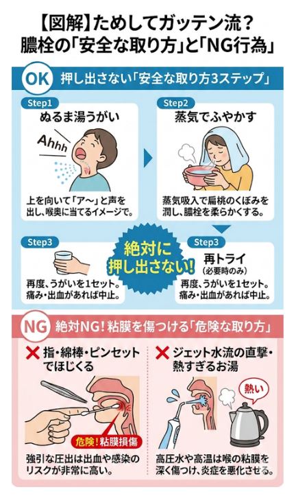 ためしてガッテンで紹介された膿栓の安全な取り方（押し出さない3ステップ）と粘膜を傷つけるNG行為